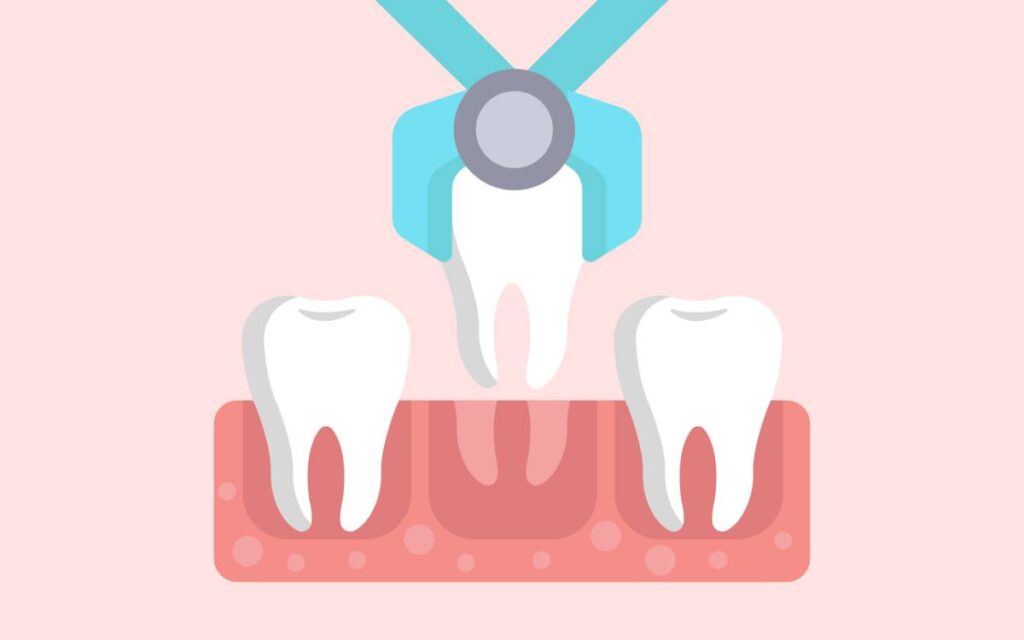 featured image for 5 reasons people need tooth extractions