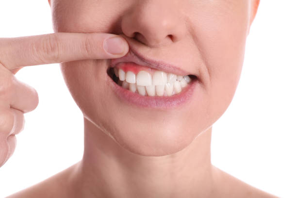 Gingivitis Specialist near me