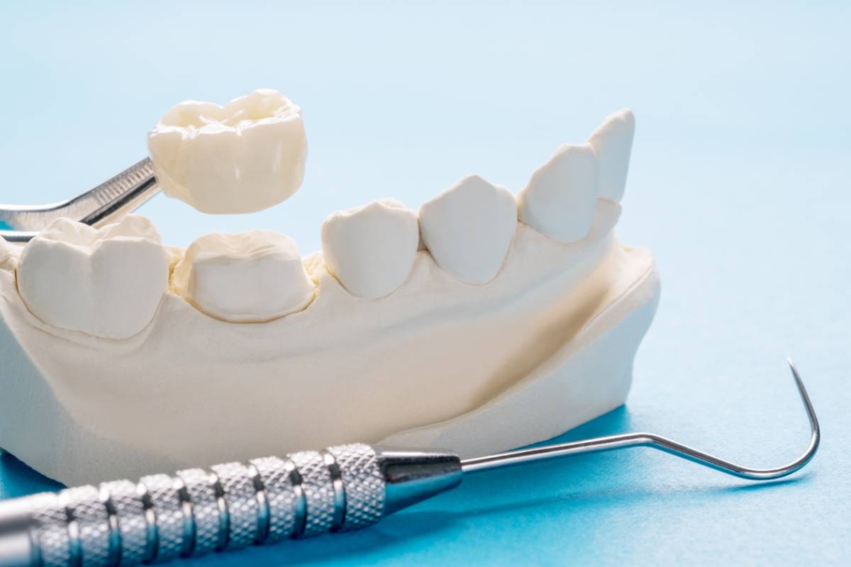concept image of dental crown replacement