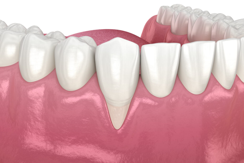 Gum recession treatment in Beverly Hills