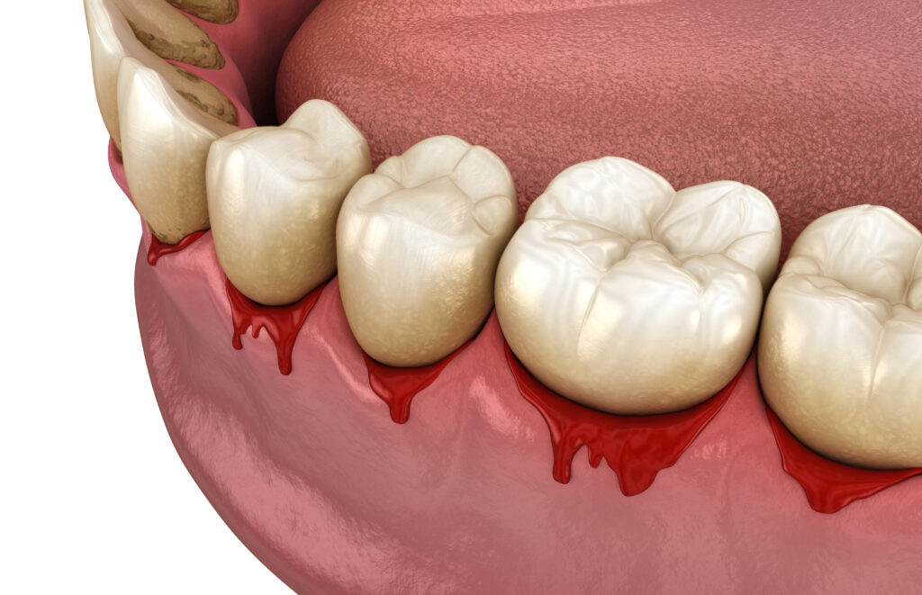 Bleeding gums are not normal in Beverly Hills