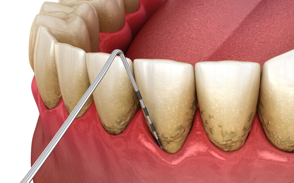 How to prevent periodontal disease in Beverly Hills