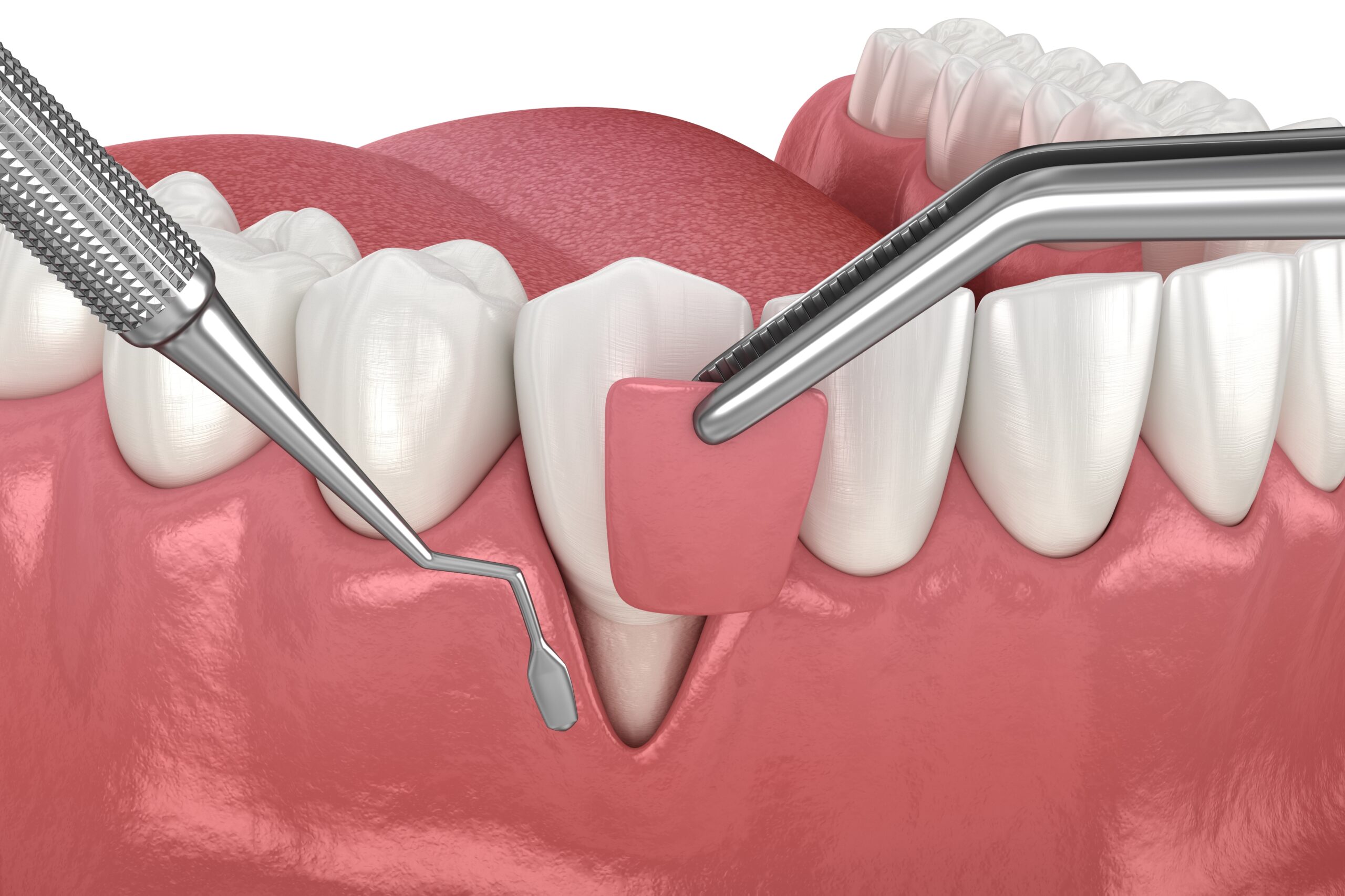 Gum recession treatment in Beverly Hills