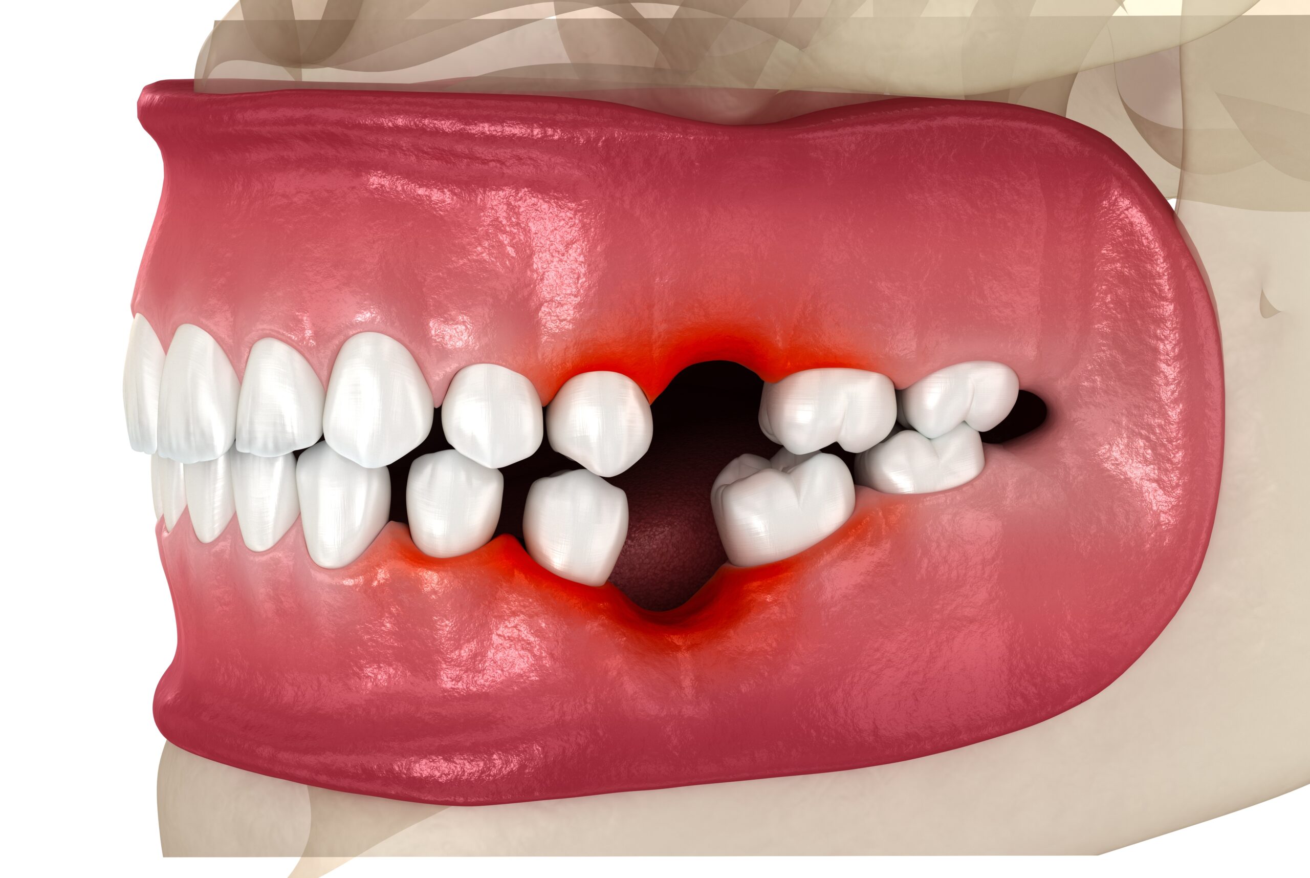 Single tooth vs multiple dental implants in Beverly Hills