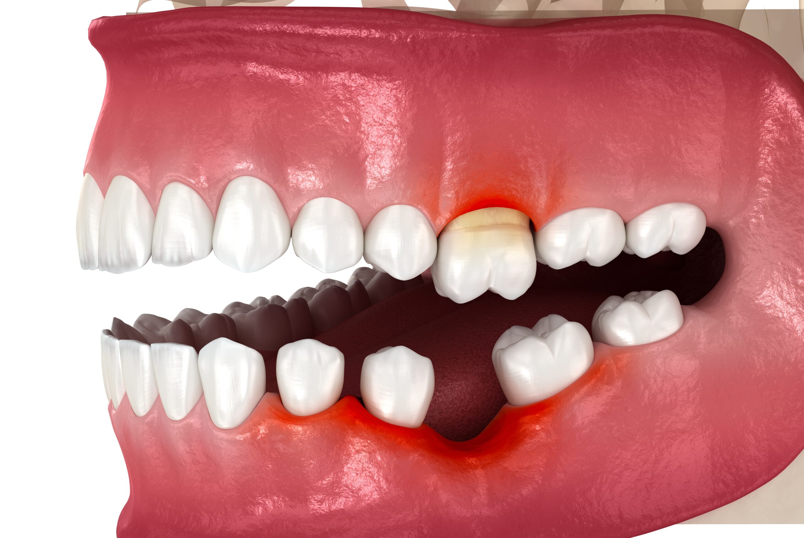 How to prevent periodontal disease in Beverly Hills