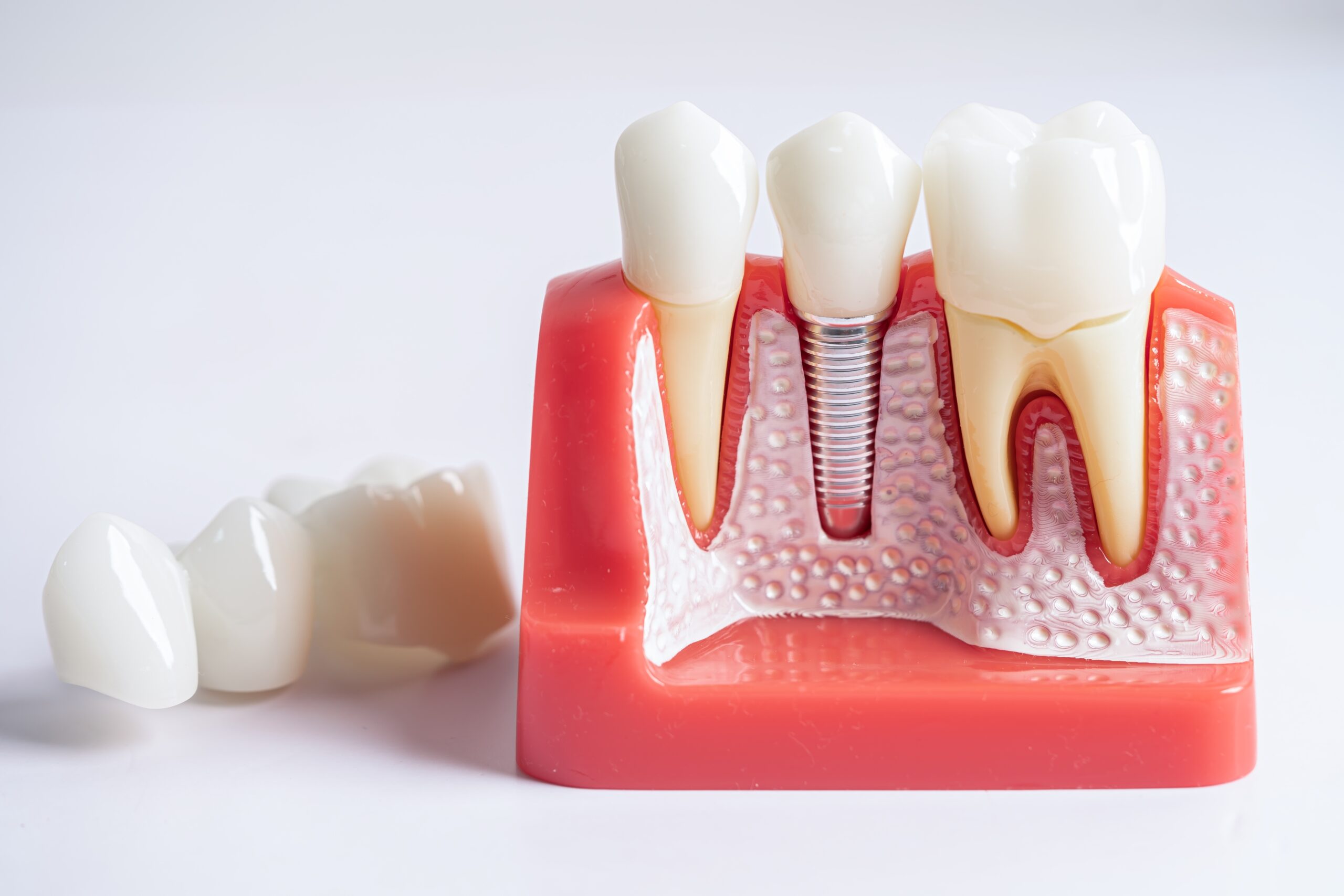 Dental implants vs dentures in Beverly Hills