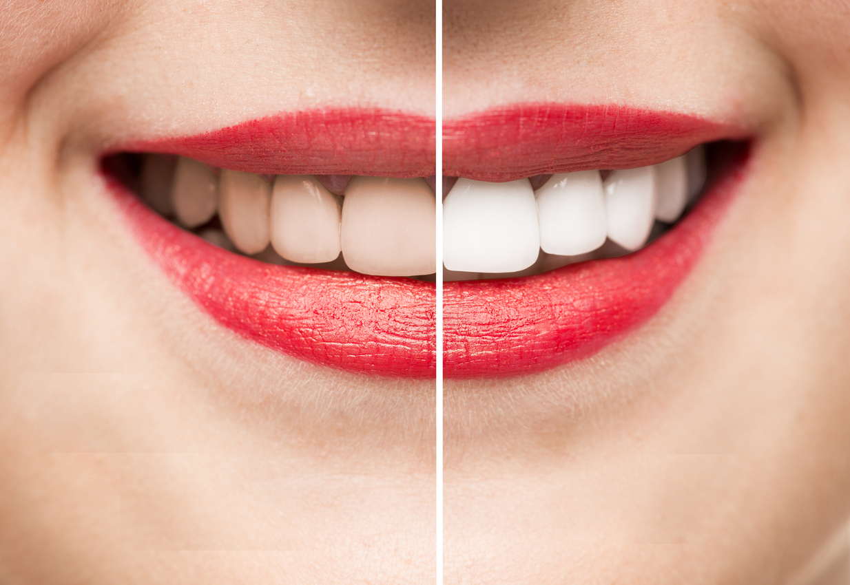 woman smiling with beverly hills teeth whitening before and after